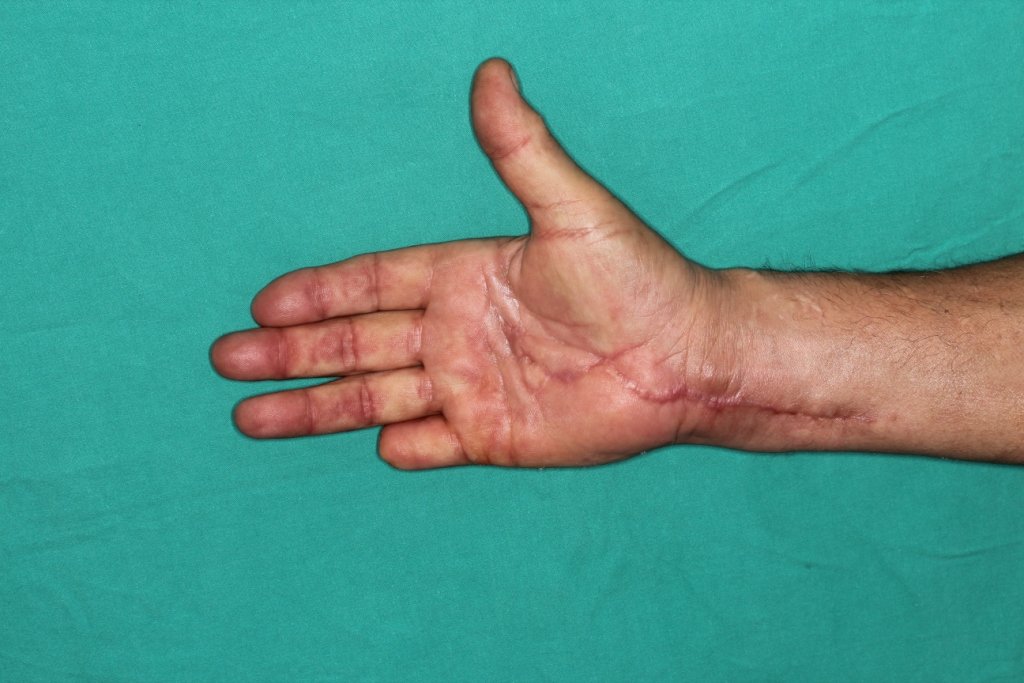¿Qué debes hacer ante la amputación accidental de un dedo de la mano?