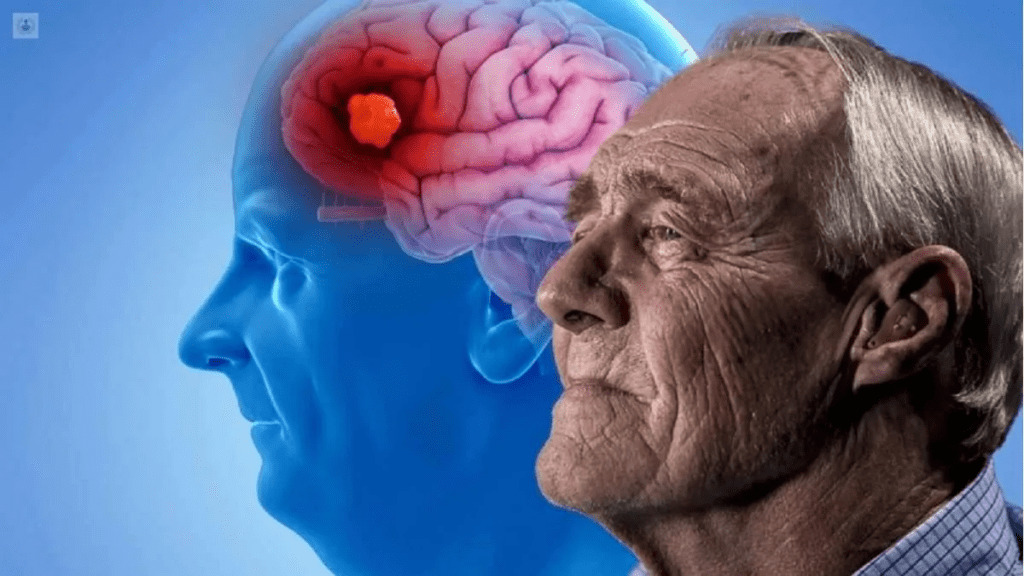 EEUU | Científicos señalan que la propagación del Alzheimer es mayor de lo que se cree