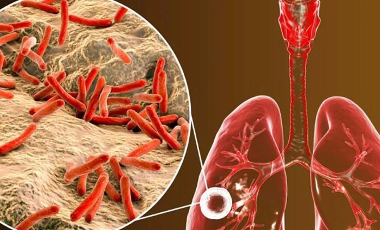 Alertan aumento de casos de tuberculosis en Nueva Esparta Mantente informado a través de nuestras redes Twitter, Instagram, Facebook y YouTube síguenos