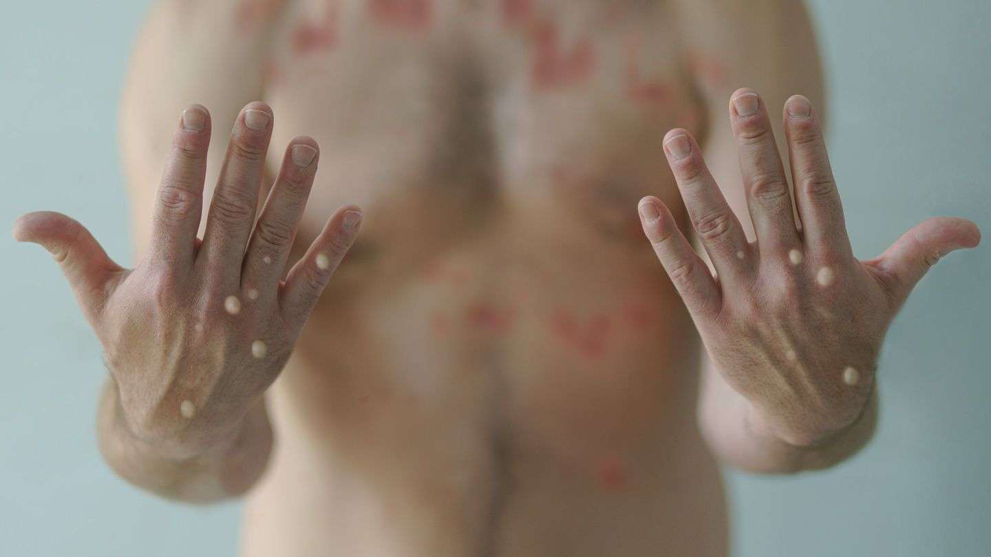 what-is-monkey-pox-1440x810 Mpox