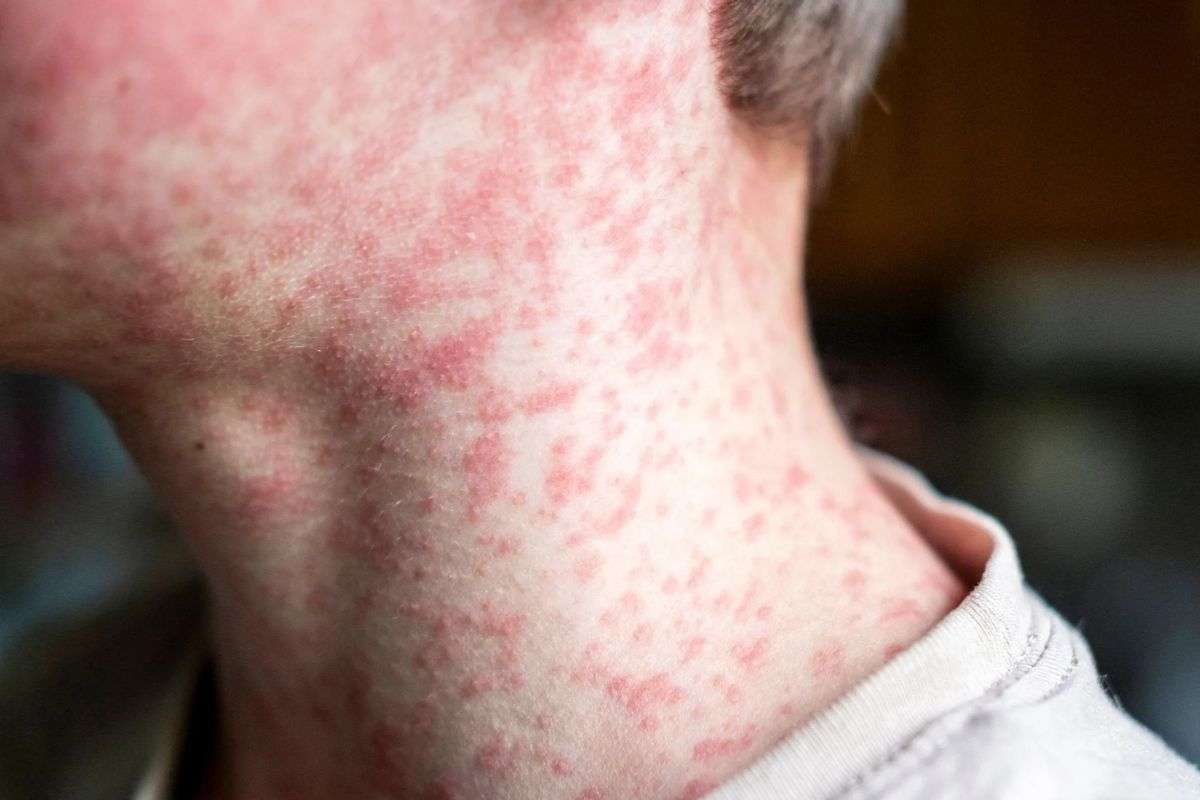 Sarampión resurge en 10 países de América